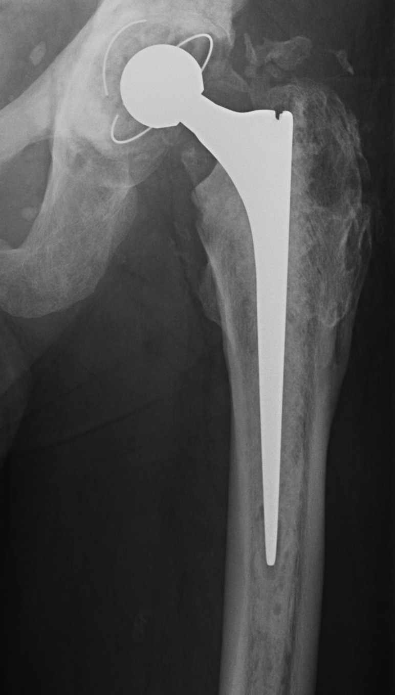 Cemented Femur Possibly Loose